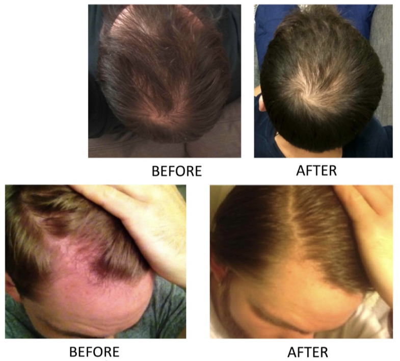 MyProtocols's tweet photo. Twice-daily scalp massage stabilized or regrew hair in 69% of men with male pattern baldness.

Each 20-minute massage involved:

- 3 min warm-up: cyclical presses across the whole scalp (5-10 lbs of force per hand)
- 6 min of pinches: gripping the scalp skin (5-10 lbs), held 1-2 seconds each
- 6 min of presses: knuckle or palm-based presses into the scalp (10-20 lbs), held 1-2 seconds each
- 5 min of stretches: firmly stretching the scalp skin, held 1-2 seconds each

Each session targeting one of three regions:

1) Front/temples
2) Crown
3) Sides/back

Changes appeared after ~36 hours of total massage, and the more men massaged (both per day and over the months) the greater the improvement, independent of finasteride or minoxidil usage.

Worth noting: 
Self-reported survey data, not a controlled trial.