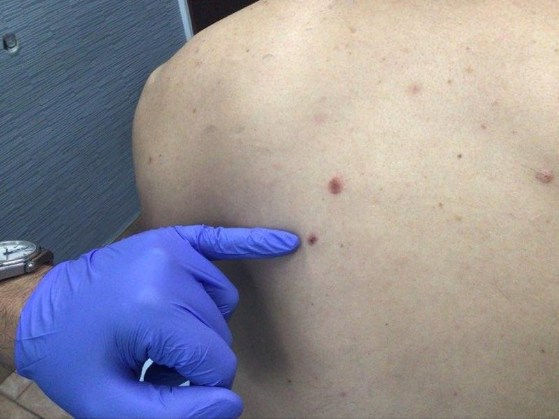 schowardjd's tweet photo. The diagnosis is eruptive halo nevi following melanoma excision.

Halo nevi are benign melanocytic nevi surrounded by a rim of depigmentation caused by a T-cell–mediated immune response against melanocytes. Although most commonly seen in children & young adults, the sudden appearance of multiple halo nevi in adults should prompt evaluation for an underlying malignancy, particularly melanoma.

In this case, a man in his 30s underwent excision of a 0.8-mm, nonulcerated melanoma w/ -ve margins & -ve SLNB. Three months later, multiple preexisting nevi on the back developed halo depigmentation. The melanoma specimen demonstrated a brisk lymphocytic infiltrate, supporting an antitumor immune response that may have cross-reacted with melanocytic antigens in distant nevi, leading to their regression.

Eruptive halo nevi have been reported in association with melanoma, immune checkpoint inhibitors, autoimmune diseases, viral infections, and, rarely, following melanoma excision alone. The mechanism is thought to involve immune recognition of shared melanocyte antigens, resulting in cytotoxic T-cell–mediated destruction of melanocytes in both melanoma cells & benign nevi.