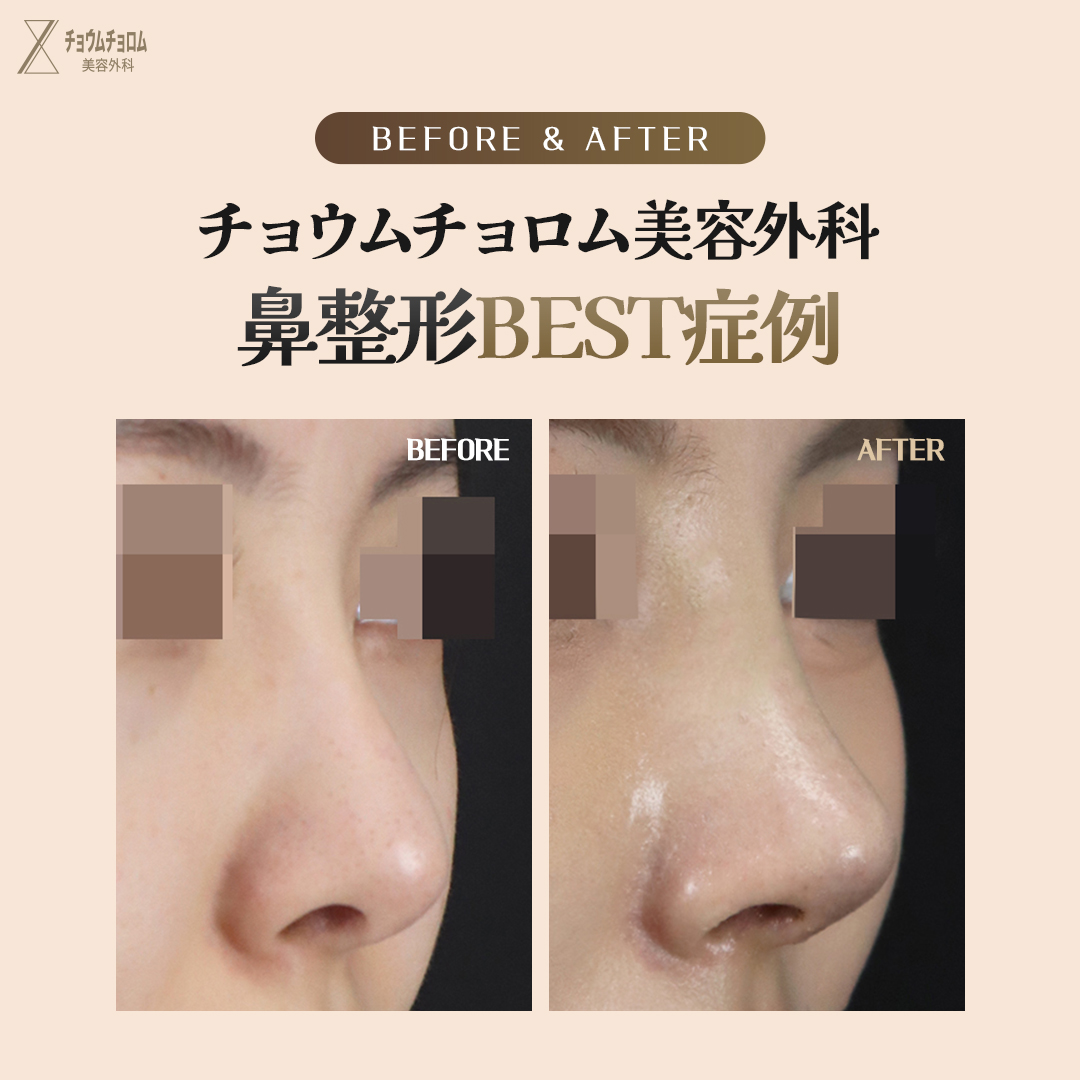 likefirst_jp's tweet photo. チョウムチョロムが教える
#整形手術 Before&After

目、鼻手術はすべて自信あります。
チョウムチョロム美容外科では’工場式’のような画一的な手術は行いません。
患者の目、鼻の形と年齢、シーズンなどの状態に合わせて
1：1パーソナライズで安全に手術を行う事をお約束します。
カウンセリングから手術、後管理まで代表院長1：1責任制で全ての過程を担当し、
嘘のない診療を行います。

#チョウムチョロム美容整形外科　#目整形　#鼻整形
#代表院長パーソナライズカウンセリング無料
#江南駅

#チョウムチョロム美容整形外科 #鼻整形 #小鼻縮小 #ナチュラル #鼻整形 #鼻再手術 #拘縮鼻 #韓国整形 #鼻中隔延長 #鼻鏧形レポ #鼻先 #鼻形 #美容整形 #形 #軟骨移植 #鼻整形レビュー #プチ軽形 #中年整形 #美意識 #美容オタク #美容整形外科 #形メイク #鼻尖形成 #軟骨移植 #鼻整形レポ #整形レポ #美容整形 #美容外科 #美容整形外科 #韓国ビューティー