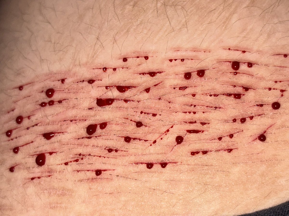 softstaticnbjc's tweet photo. Small sesh #shtwt #sh #selfharm #shedtwt #cutsspotwt #cutspotwt #slittwt #suicidetwt #988twt https://t.co/zL1ODNQata