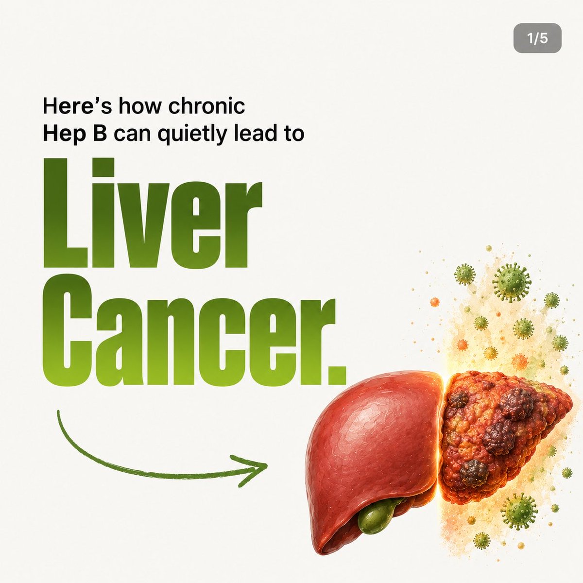 LiverTrackerApp's tweet photo. Chronic Hep B is a silent virus that can quietly lead to liver cancer over decades. Early detection changes everything. If you have chronic HBV, getting an ultrasound + AFP blood test every 6 months is key.
Track your scans for free at https://t.co/qSaND3o5xx. 🛡️ https://t.co/Xu4bTSHzaf