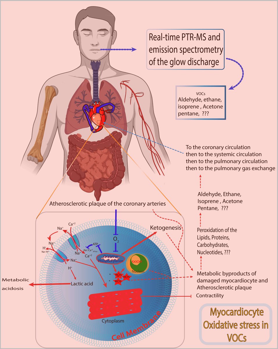 RCMjournal's tweet photo. 💡Can #OxidativeStress in #Cardiomyocytes be detected through #BreathAnalysis to revolutionize #IschemicHeartDisease diagnostics?
This study maps the journey of #VOCs from heart to breath, revealing a #Breathomics signature for #IHD.
🧠The latest work from Sechenov University by first author Dr. Basheer Abdullah Marzoog @basheermarzoog and his team is now featured in RCM!
👉: https://t.co/Q7CR9ShyHC
#Cardiology #VOCs #HeartHealth #MedTwitter #Biomarkers #CardioEd