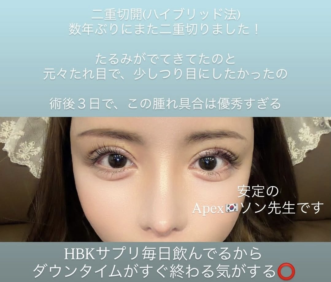 nyunnyun05's tweet photo. 一条響ちゃんが二重切開した病院と先生公開してくれた👨‍⚕️✨
- Apex🇰🇷エイペックス美容形成外科
- ソン・ヒョンソク院長

二重切開(ハイブリッド法)
ちょいつり目の希望の目元&amp;たるみが改善されるらしくて最高すぎんか何より術後３日目とは思えない腫れのなさ経過が良すぎる
#整形垢さんと繋がりたい https://t.co/a9PL7q4KXi