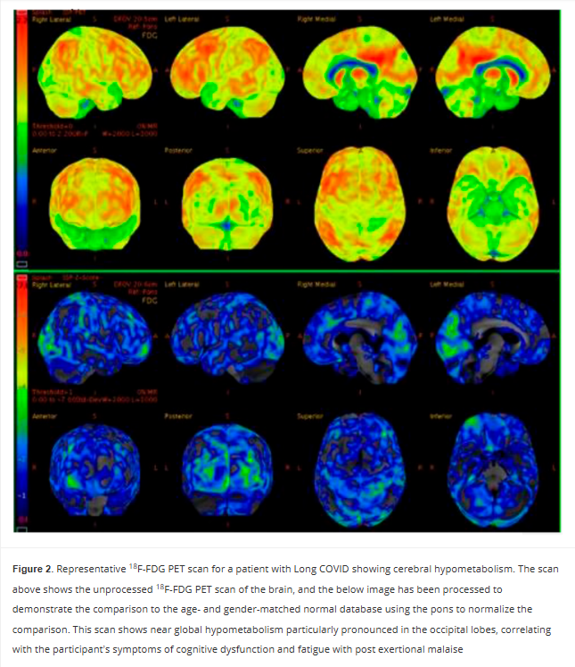 HarrySpoelstra's tweet photo. Persistent Cerebral 18-FDG PET Changes in Patients With Long COVID Presenting With Fatigue and Post Exertional Malaise

🚨We already knew Long COVID brain damage could last 6 months.
Now this new PET scan study proves it’s still there at 2 YEARS and counting.
Hypometabolism hits the left sensorimotor cortex (movement + body sense), left superior parietal (spatial awareness + attention), and bilateral visual cortex (raw sight processing).
This is NOT just “tired.” 
This is a broken sensory-motor command center.
Is this the start of a lifelong neurological disease?

➡️Mayo Clinic observational cohort study of 40 Long COVID patients (70% female, median age 53) from a specialized clinic who underwent brain 18F-FDG PET-CT scans 17–149 weeks (median 62 weeks) after SarsCoV2 infection,

➡️73% had predominant fatigue with post-exertional malaise (PEM),

➡️This group showed statistically significant cerebral hypometabolism vs. non-PEM patients in the left sensorimotor cortex (p=0.0253), left superior parietal cortex (p=0.0276), and bilateral primary visual cortex (p=0.0096 and 0.0016),

➡️Abnormalities persisted already up to ~2 years post-infection,

➡️Scans used pons-normalized Z-scores against age/gender-matched controls with common comorbidities included psychiatric, GI, and cardiovascular conditions,

➡️Caveat: No references to vaccination status and/or reinfections,

➡️Authors propose 18F-FDG PET-CT as a potential diagnostic and therapeutic biomarker for the fatigue/PEM phenotype of Long COVID.

‼️So, AGAIN, Long COVID fatigue and PEM have a demonstrable, persistent neurological signature! Cerebral hypometabolism, still detectable on PET scans up to two years later and hits the left sensorimotor cortex (movement + body sense), left superior parietal cortex (spatial awareness + attention), and bilateral primary visual cortex (raw sight processing).

This isn’t just “tired.”

It’s a broken sensory-motor command center.

😡Study proves LC is biologically real, not psychosomatic or any other stupid FND diagnosis.

Without urgent validation of this biomarker and targeted therapies, patients will continue to be dismissed despite objective brain damage!
#AvoidSars2 #AvoidReinfections #BrainDamage
https://t.co/OfoOlgDyt0