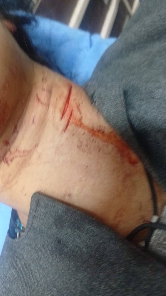 Javid__Mir's tweet photo. Strongly condemn another leopard attack in Khanabal, Manzpathra, Chowkibal, in which Afsana Begum was seriously injured. Authorities must act immediately to capture the leopard and ensure public safety. Human lives cannot be put at risk any longer. https://t.co/I1UBhKNJGg