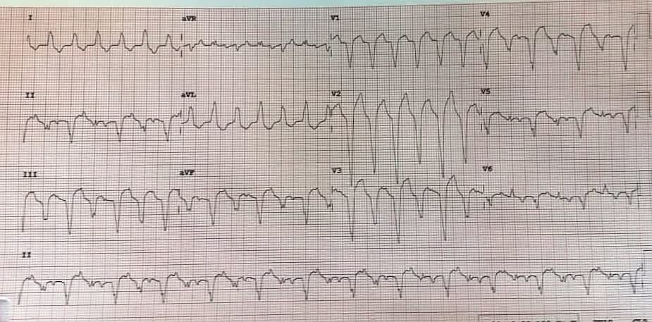 YilmazEile63275's tweet photo. What is the diagnosis?
@syamkumarmd @SergioPinski @Koichi16423232 @Arron_Pearce_ @ALFIEEP1 @DrMCardiology @doctor_roig @ecgandrhythmRoe @ECGEPSCADEVICE @hhuang123 @fvassallomd @The_Nanashi_O @jeffrey_vinocur @KostekMilan @KTamirisaMD @MattMelcherPA
@melhamriti @ugurcanpolatmd https://t.co/dmksMRXwCp