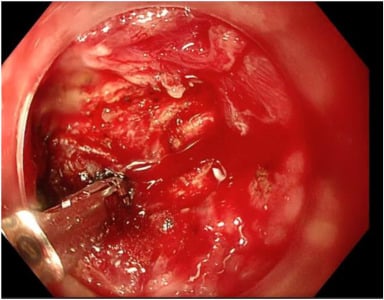 ASGEendoscopy's tweet photo. VideoGIE Editor's Choice: "Endoscopic anastomotic reconstruction with lumen-apposing metal stents" by Andrew Thushyanthan et al. Watch it here: https://t.co/rruNmoqyHD #GITwitter #VideoGIE https://t.co/riKxYMxzN5