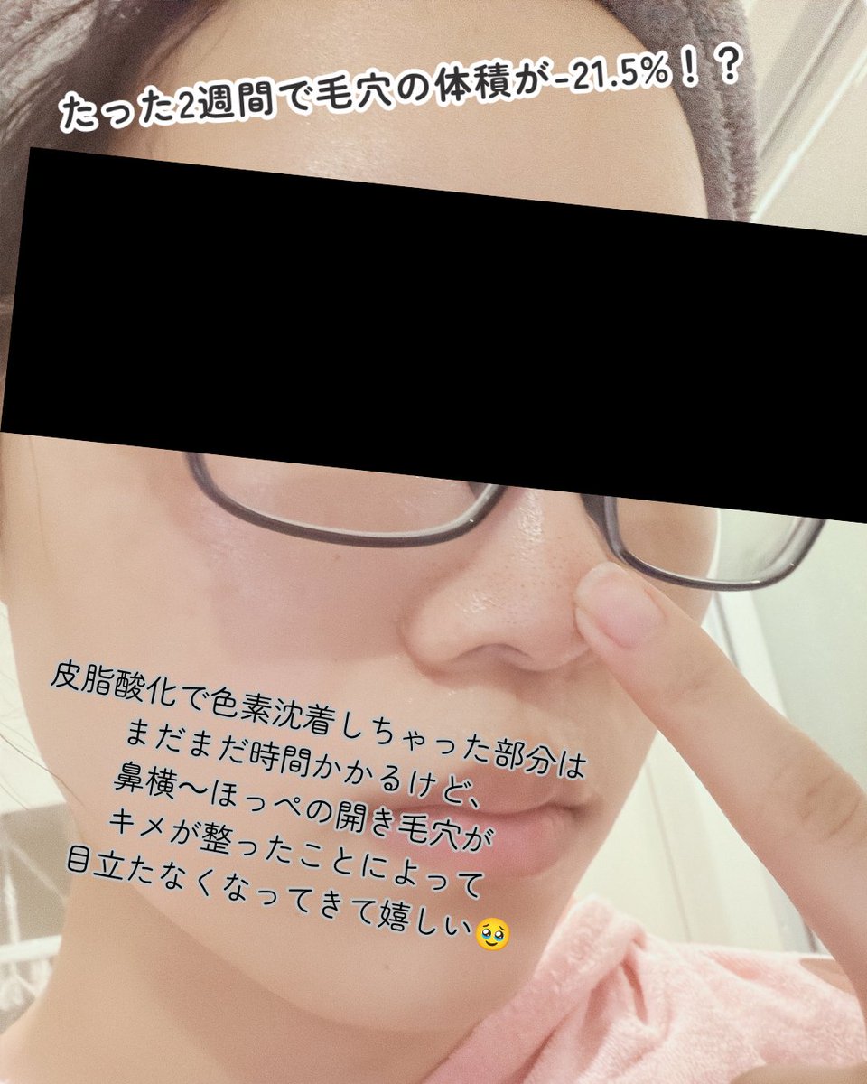 riri_xxxxx_0_0's tweet photo. PR🍀Odeloi 第2期 CREWの発信です
メガ割、いよいよ最終日だよ😭😭みんな後悔はないかい😭😭
今だからこそ紹介したいこの商品、ぜひ見てってね👇

前回は、オドロイのクレンザーを紹介したよ。脂性肌だから黒ずみが詰まりがちの鼻の毛穴、だいぶすっきりしました🥹
でも毛穴って、洗うだけでは終わらない！綺麗になったなら閉じないとまた外の汚れとかが詰まっちゃう

そこで、すかさずOdeloi（ @odeloi_jp ）さん、次の武器を持ってきます。
✓オドロイ ブラックチェリー 毛穴縮小クリーム ルフティグ

毛穴縮小クリームって名前だけでもううずうずしちゃうよね？ブラックチェリー果実エキスやプルヌスセロチナ果実エキスがたっぷり配合されていて、抗酸化作用、うるおいなどが期待できる！
本製品は 人体適用試験を完了していて、 たった2週間で使用で広くなった毛穴の縮小（毛穴の体積 -21.5%、毛穴の面積 -19.6%）に役立つことが立証されてるんだって…！しかもシワ改善機能性化粧品でもあるから、もう嬉しいこと尽くし！

今ならお得価格で買えるだけでなく、クリーム購入で大勝アイテムを1点ランダムプレゼントまであるんだって！
最後の駆け込み、ぜひぜひOdeloiさんの商品も覗いてってね～！
#ODELOI #オドロイ #ファンデ密着クリーム #メイクのりクリーム