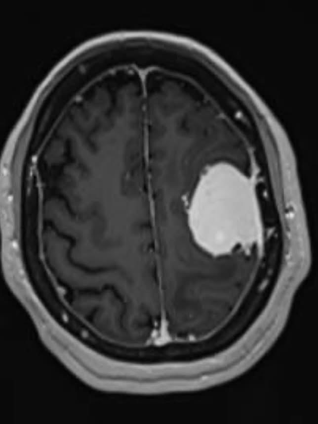 CieloYolandaBe1's tweet photo. 🧠💔 Llevo más de 5 años luchando SOLA contra un Meningioma Clinoideo derecho. 
28 sesiones de radioterapia, pérdida de visión en un ojo y convulsiones constantes… 

Ya no puedo más sola. Necesito ayuda urgente para continuar el tratamiento y mi historia completa está aquí 👇

https://t.co/UF9YJGcpj3

Si crees en los milagros, **RT** y etiqueta a alguien con buen corazón (influencers, medios, cuentas de salud, amigos). 
Cada compartido es una esperanza para mí.

Yolanda Beltrán ❤️ 
@CieloYolandaBe1 
#Meningioma #TumorCerebral #Cancer #Ayuda #Mexico #LuchaContraElCancer #EnfermedadesRaras #BrainTumor #RareDisease #Esperanza