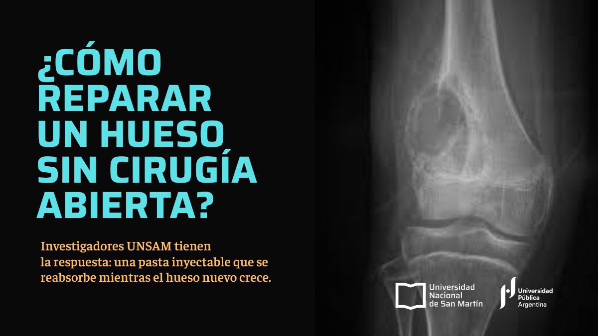 unsamoficial's tweet photo. Investigadores de #UNSAM desarrollan un material biocompatible que pueda implantarse en el cuerpo del paciente mediante procedimientos mínimamente invasivos. El objetivo: crear una solución innovadora para mejorar el tratamiento de quistes óseos.
https://t.co/0nMNhpuGwU https://t.co/Roo6Vr8rRf