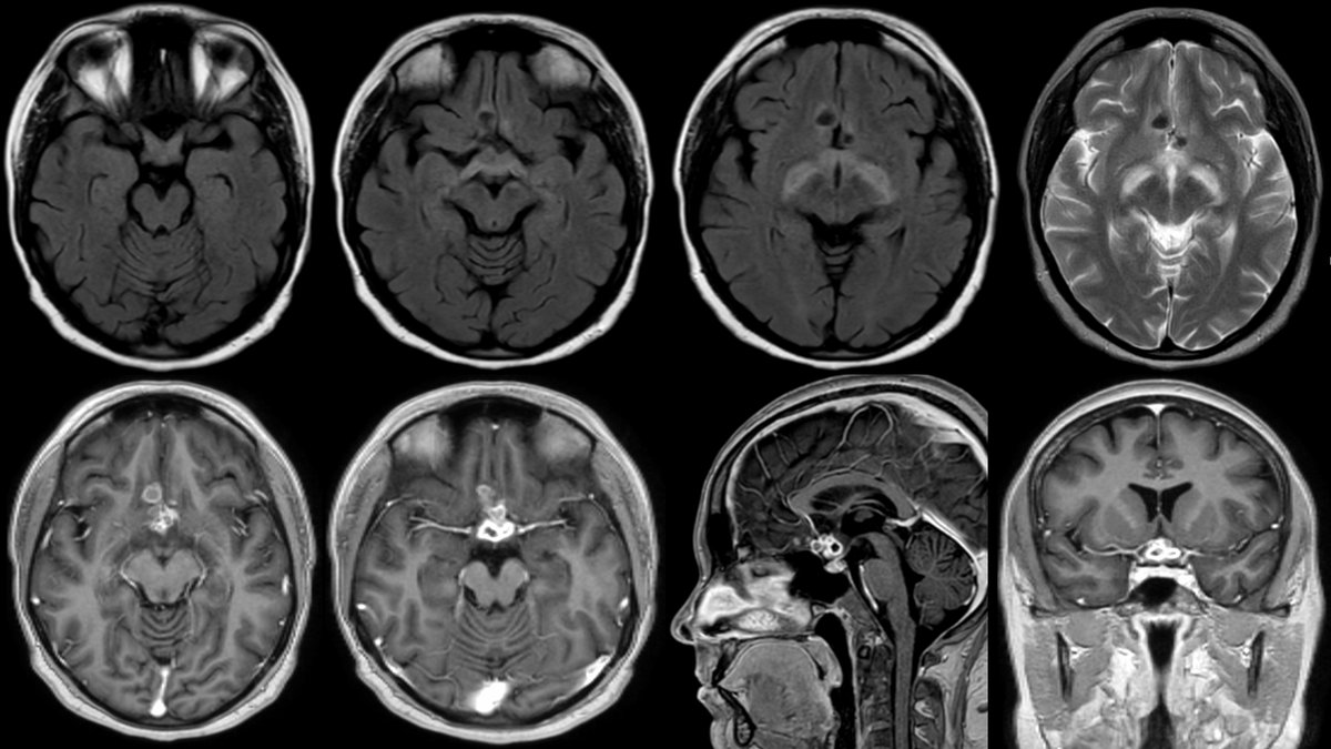 nirmalregency's tweet photo. Not all optochiasmatic arachnoiditis lesions are paradoxical reactions, many of them may be primary TB granulomatous lesions. 
https://t.co/rl1Zt5FLyl https://t.co/otrwAZsZUo