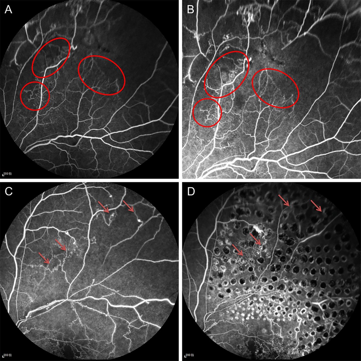 AAOjournal's tweet photo. Intraoperative Anti-VEGF Versus Photocoagulation During Vitrectomy for BRVO with Vitreous Hemorrhage: A Randomized Clinical Trial
https://t.co/aVA9k41TTN
#ophthalmology https://t.co/cVvBwqTHKM