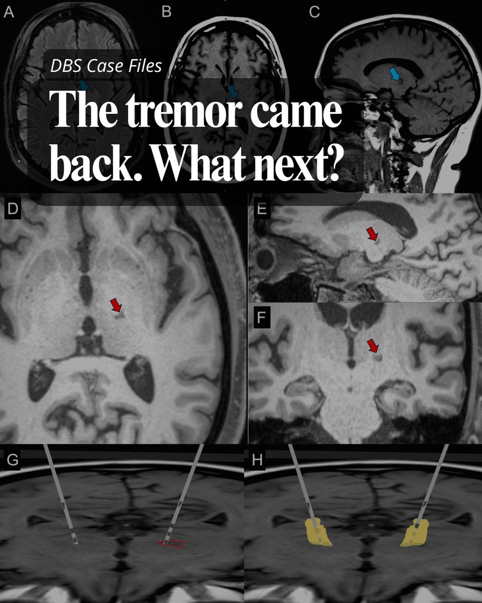FixelInstitute's tweet photo. What happens when tremor comes back? A Fixel/UF case study found that after symptom recurrence following focused ultrasound, staged bilateral DBS restored tremor control. The findings highlight DBS as a potential option when tremor returns
Full case: https://t.co/z7RZ10IrWU https://t.co/qKTsqiQ0BR