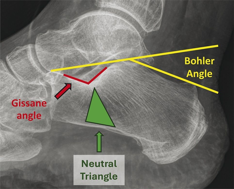 MoAImam's tweet photo. If your patient presents with a calcaneus fracture and you aren’t sure what to do, this JAAOS article can provide guidance: https://t.co/l2Olm0wOkd https://t.co/SVXMv6mdmo