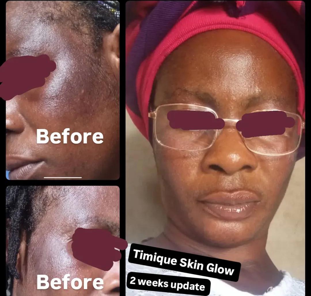 TimiqueSkinGlow's tweet photo. Skin repair in progress!
Just a couple of days using Timique Skin Glow products and her natural glow is already making a comeback. We can't wait to show you the final results.

#hyperpigmentation #darkspots #glowingskin #discolouration #fypシ゚viral https://t.co/5a5pSvP03h