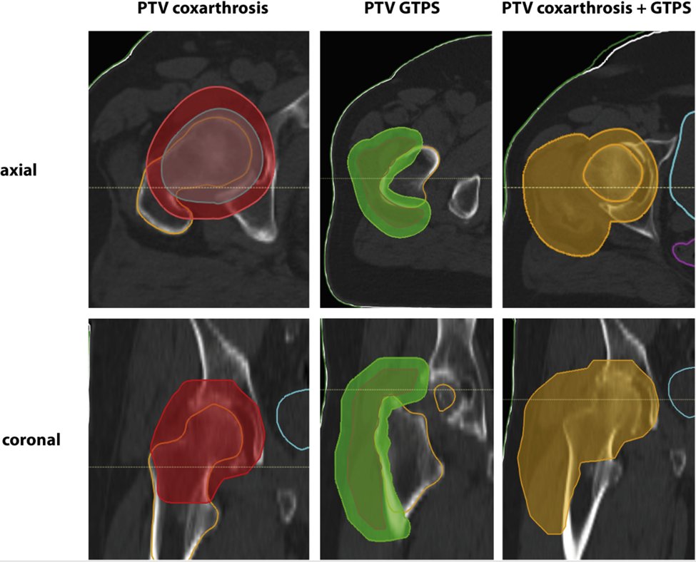 PDBrownOnc's tweet photo. LDRT for Greater Trochanteric Pain Syndrome (GTPS) and/or Hip OA
Response rate 64% GTPS, 58% Hip OA
↓↓response GTPS symptoms > 1yr, pain flare, hip prosthesis
↓↓response Hip OA BMI > 25, pain flare, >70yo
https://t.co/vz9a6ZFNx1 https://t.co/CvqXPY8Il8