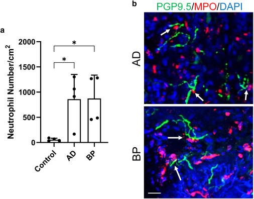 jidinnovations's tweet photo. From the May issue: A neuroimmune axis linking S100A8/9 to itch sensitization in both bullous pemphigoid and atopic dermatitis https://t.co/9Pd5vArTPD  #S100A8 #BullousPemphigoid #AtopicDermatitis #medderm #dermtiwtter https://t.co/vMjNjGh7da
