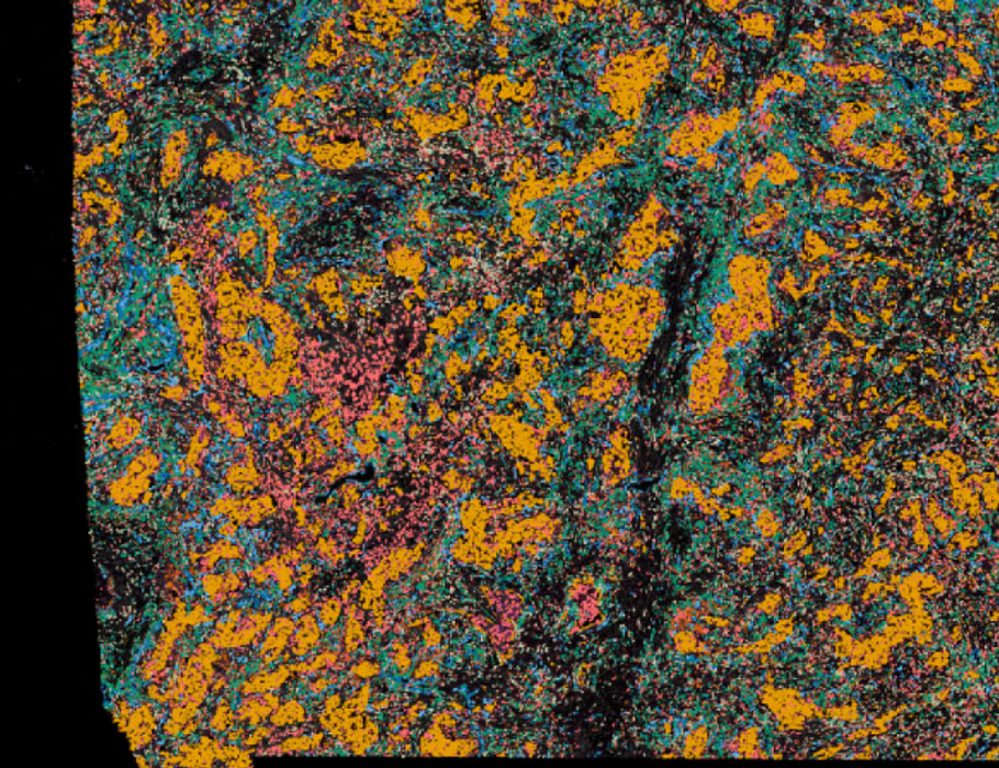 SciImmunology's tweet photo. A new Science #Immunology study has identified subsets of tumor-associated #NaturalKiller cells in patients with lung #cancer, and shows that a subset of CD39+ cells can be selectively targeted to boost cytotoxicity ex vivo. https://t.co/aBLlS0r8PK https://t.co/DJphbYGynV