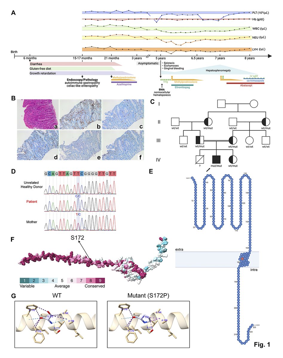 jhumimmunity's tweet photo. Mehmet Cihangir Çatak, Bernice Lo @SidraMedicine, Safa Baris @marmara1883 et al. describe the first case of homozygous #CTLA4 deficiency, which drives severe early-onset #autoimmunity through profound T and B cell dysregulation. https://t.co/u5EsqA3DCP
#Diagnostics #Therapeutics https://t.co/nT3ATdeZbO