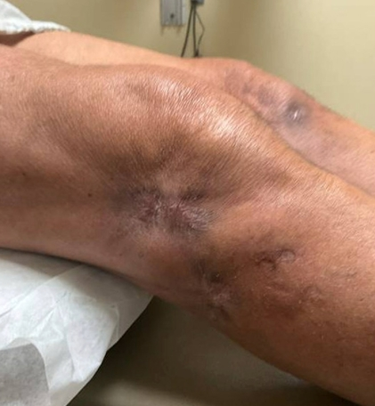 schowardjd's tweet photo. Necrobiotic xanthogranuloma (NXG)   

NXG is a rare non-Langerhans cell histiocytosis strongly associated with IgG monoclonal gammopathies, including MGUS & plasma cell dyscrasias. The combination of recurrent periocular yellow-brown papules & plaques disseminated xanthomatous lesions with ulceration, IgG-λ MGUS, pancytopenia, & characteristic histopath showing palisading granulomatous inflammation with necrobiosis and cholesterol clefts is highly diagnostic.  

In this patient, prior therapies w/ prednisone & IVIG were ineffective or poorly tolerated. Initiation of lenalidomide 5 mg daily resulted in marked improvement within 4 months, including complete healing of the knee ulcer (see infra), regression of periocular and cutaneous plaques, and normalization of a previously severe anemia (hemoglobin increased from 7.4 to 14 g/dL). When the dose was reduced because of leukopenia, new ulcers developed, suggesting a dose-dependent treatment effect.  

NXG most commonly presents w/ slowly progressive periocular xanthomatous plaques but may become disseminated & ulcerative. Ocular involvement is common but not universal. Given its strong association w/ monoclonal gammopathies, evaluation for underlying plasma cell disorders is essential.  

Although no standard therapy exists, reported treatments include corticosteroids, IVIG, alkylating agents, interferon-α, & immunomodulatory agents.