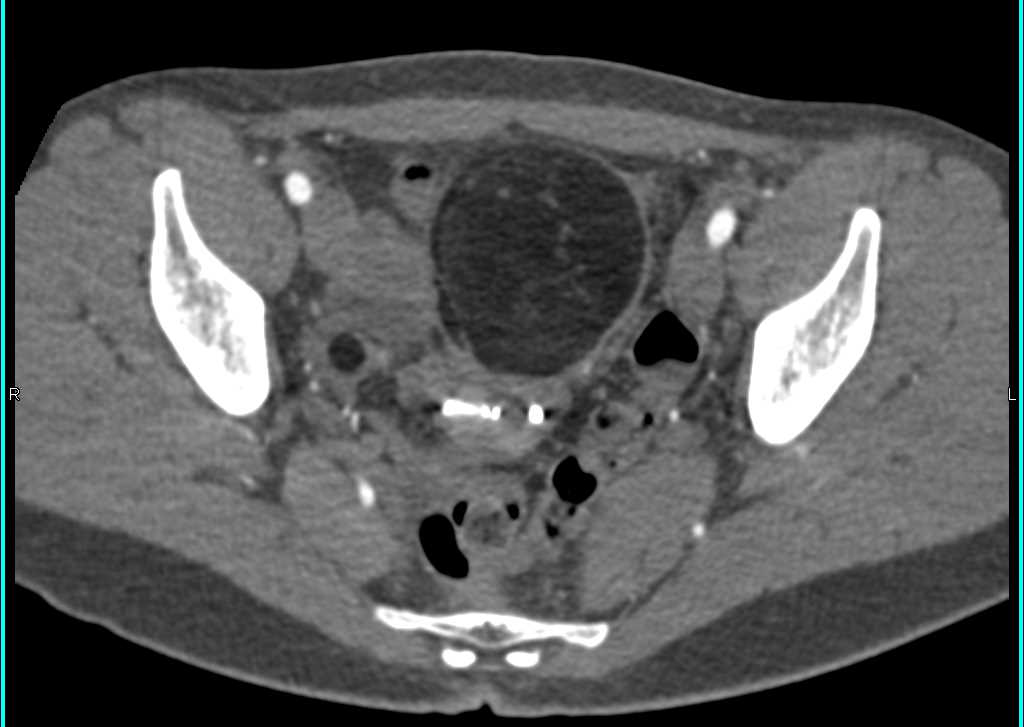 ctisus's tweet photo. Case 2: what is the dx?

The answer is here: https://t.co/buMcBV4OsA https://t.co/FwzghffmIn