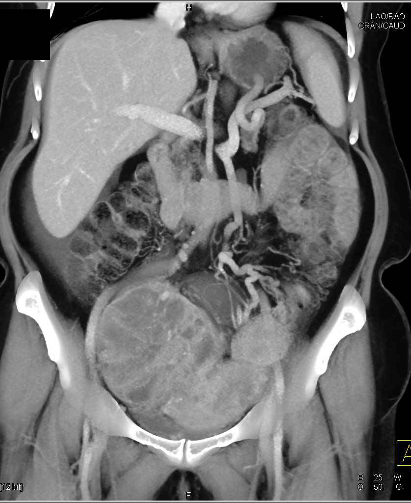 ctisus's tweet photo. Case 6: what is the dx?

Answer here: https://t.co/RBJtvDHAaB https://t.co/uo4nSlapS3