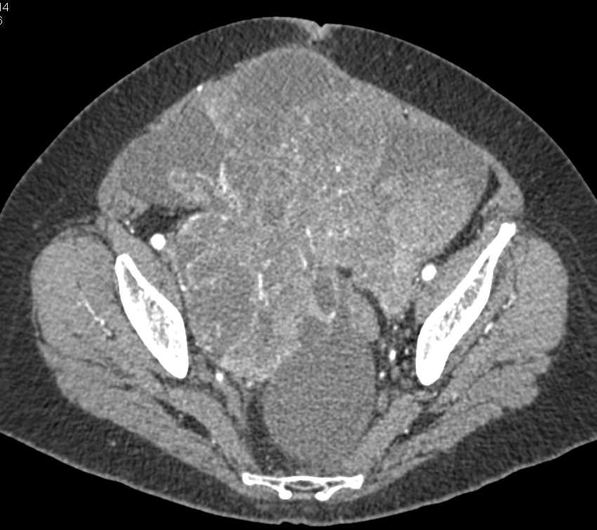 ctisus's tweet photo. Case 6: what is the dx?

Answer here: https://t.co/RBJtvDHAaB https://t.co/uo4nSlapS3
