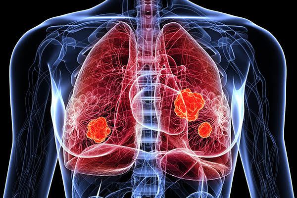 NightSkyToday's tweet photo. JUST IN🚨: The World’s First Lung Cancer Vaccine Enters Clinical Trials in Seven Countries. https://t.co/J7xbhetF38