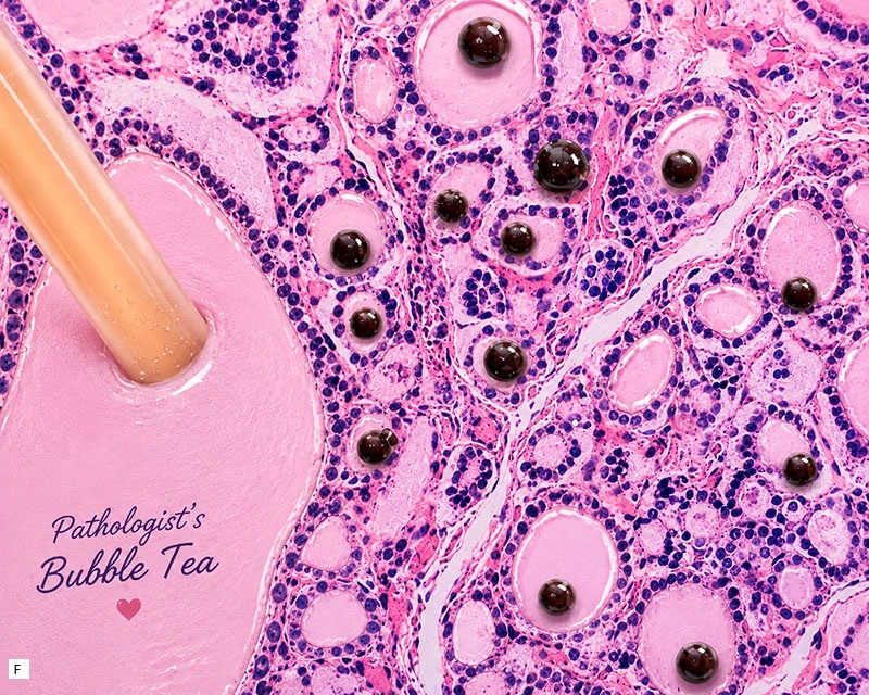 PathologyUSAH's tweet photo. (2/2) Annual PathPic contest at the @UofSouthAlabama
Category: creative/witty
Which one is your favorite?
Poll in comments 👇
PS: open the pictures to read the captions!
#Pathology #PathX #PathArt #Pathresidents #GUPath #Microbiology #Ultrastructure #BreastPathology https://t.co/YUjEOBnPoE