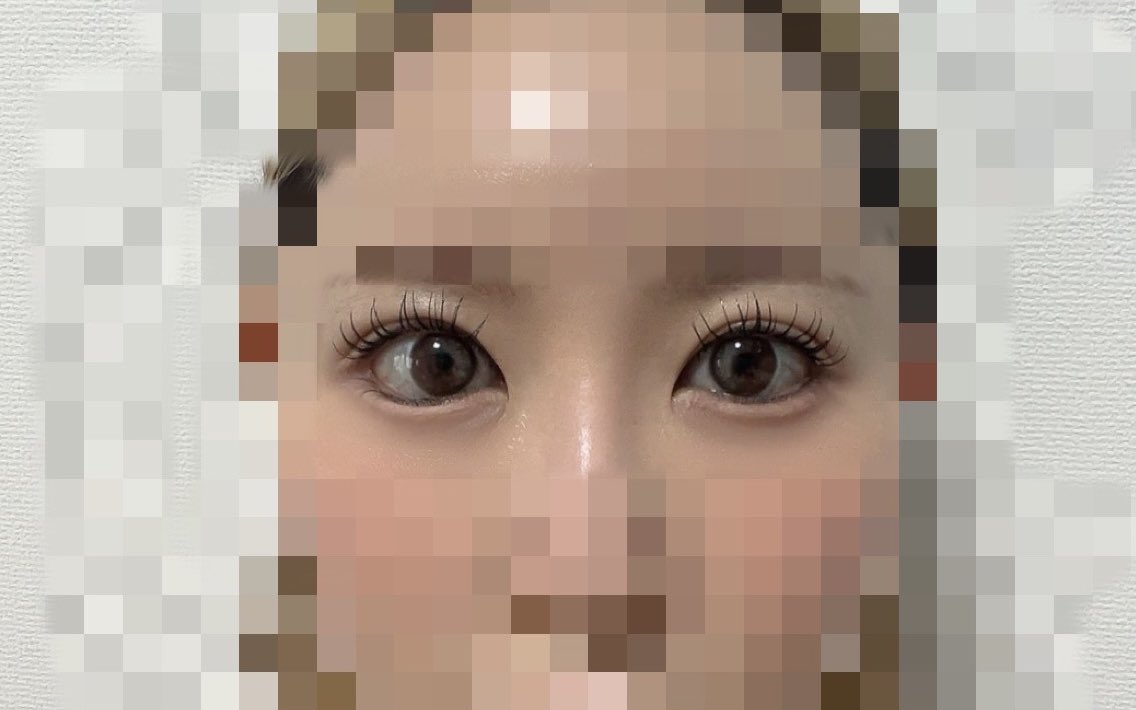 omochiyou's tweet photo. @ABPRS_JP 
AB美容外科医院で目尻目下切開して経過3ヶ月後！
写真で見比べるとかなりの変貌！

#目尻目下切開 #韓国整形 #韓国美容 #経過レポ https://t.co/uUXJP282Ur