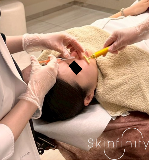 skinfinity_ks's tweet photo. 鼻は汗をかきやすく、メイクが崩れやすい部位。

汗止め目的で小鼻にボトックスを打つと、メイク崩れもしにくくなります。

脇ボトックスと並び、夏場は特に満足度の高い施術です。 https://t.co/hgaNnbk8Sp
