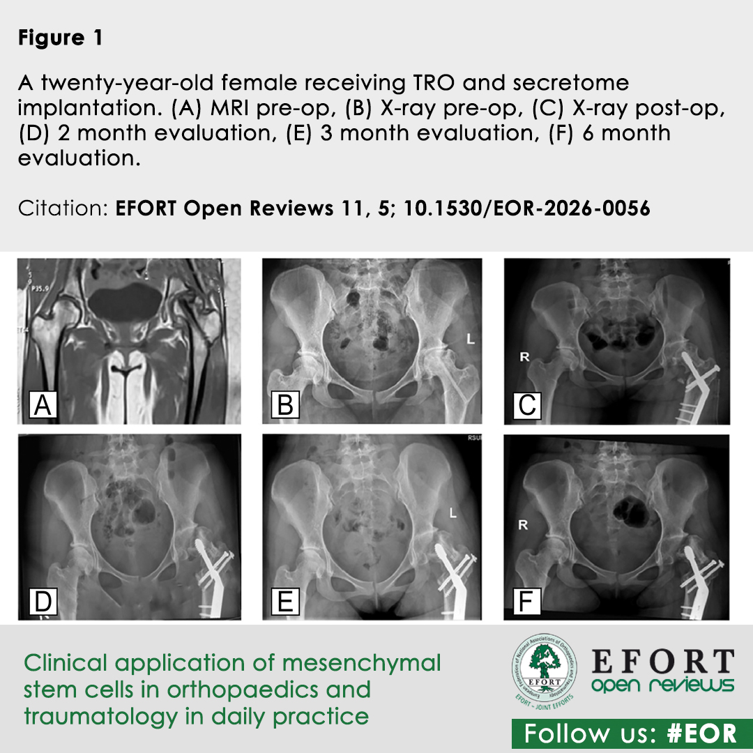 EFORTnet's tweet photo. How are #Mesenchymal #StemCells applied in daily #OT practice? ๐งฌ๐ฆด #EFORT #EOR paper highlights #StandardProtocols for 15 #ClinicalIndications, from critical #BoneDefects to #DegenerativeDiscDisease
๐ https://t.co/H2abiSU36K
#MedicalResearch #OpenAccess https://t.co/VIOP2cqbMD