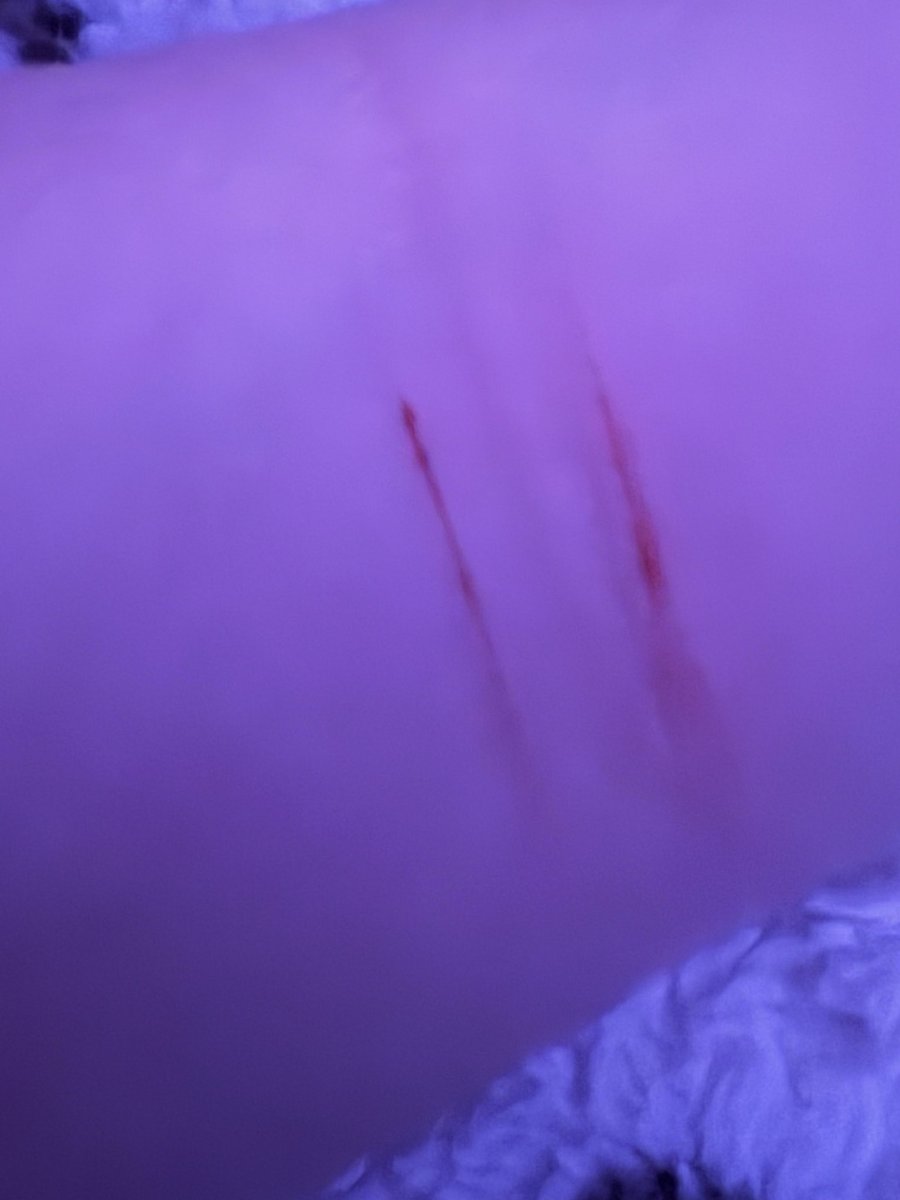Lex1x_'s tweet photo. The knife I have sucks so bad, I tried multi swiping on the same spot so many times but it just gives me tiny cuts 💔🥹 #help #fyp #sh #shtwt #slittwt #tinycuts https://t.co/OSz1zMdCLO
