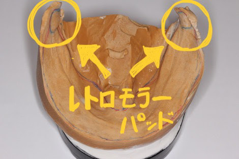 IPSG8028's tweet photo. 【下顎の総義歯がフカフカと動いてしまう】

患者さまからよくお聞きするお悩みの一つ。

下顎の総義歯が沈み込まないようにするにはどうしたらよいでしょうか？

それは。

「レトロモラーパッドを覆うこと。」

下顎においては、レトロモラーパッドは唯一、下顎で変化のない部位だからです。 続 https://t.co/SalDqdXbex