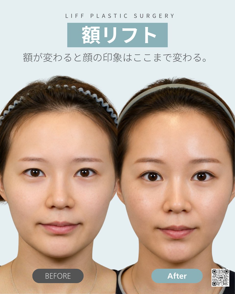 Liffpsjp's tweet photo. この投稿、とてもわかりやすいですね👨‍⚕️

実際にカウンセリングをしていると、
「昔より目が重くなった」
「眉を上げないと目が開かない」
「なんとなく疲れて見える」
というお悩みをよくお聞きします。

その原因のひとつが、年齢とともに眉の位置が下がってくることです。

実は眉毛の位置は、目元だけでなく顔全体の印象にも大きく関係しています。

眉が少し上がるだけで、
✔ 目元が明るく見える
✔ 若々しい印象になる
✔ 優しい雰囲気に見える
という変化が期待できます。

逆に、ただ高くすれば良いわけではありません。

上げすぎると不自然になったり、その方の骨格によっては顔が大きく見えてしまうこともあります。

だからこそ額リフトで大切なのは、「どれだけ引き上げるか」ではなく、「どの位置に眉をデザインするか」だと考えています。

当院では目元だけを見るのではなく、額・眉・目・フェイスラインまで含めた全体のバランスを見ながらデザインしています。

額リフトは単なる若返り手術ではなく、その方らしい自然な美しさを引き出すための手術だと考えています。

#額リフト #額挙上 #切開リフト #アンチエイジング #韓国美容外科