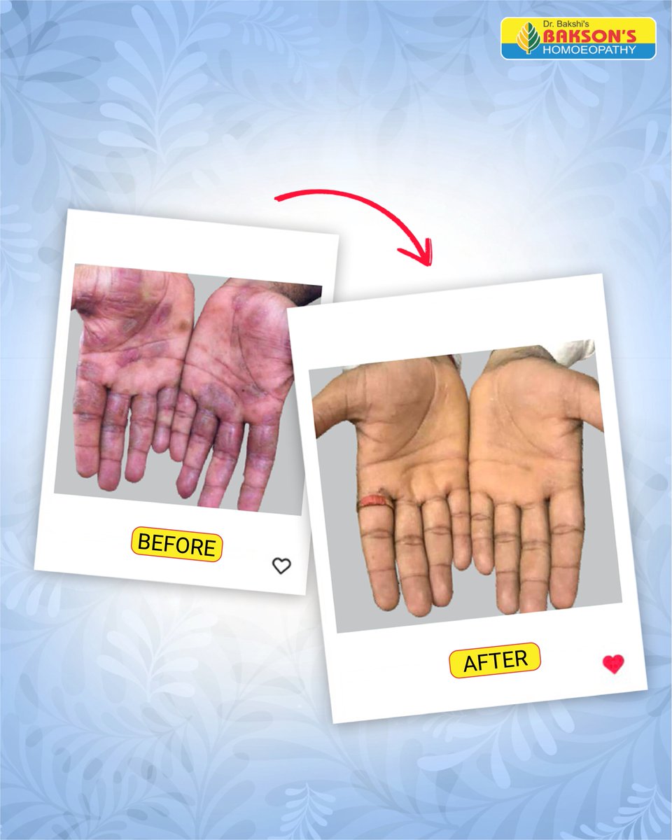 Baksons's tweet photo. Eczema affects more than just your skin.

At Bakson's Homoeopathy, we focus on holistic care that supports healthier skin, greater comfort, and renewed confidence.

#baksons #baksonshomoeopathy #eczemarelief #healthyskin https://t.co/5V1q4aYPPM