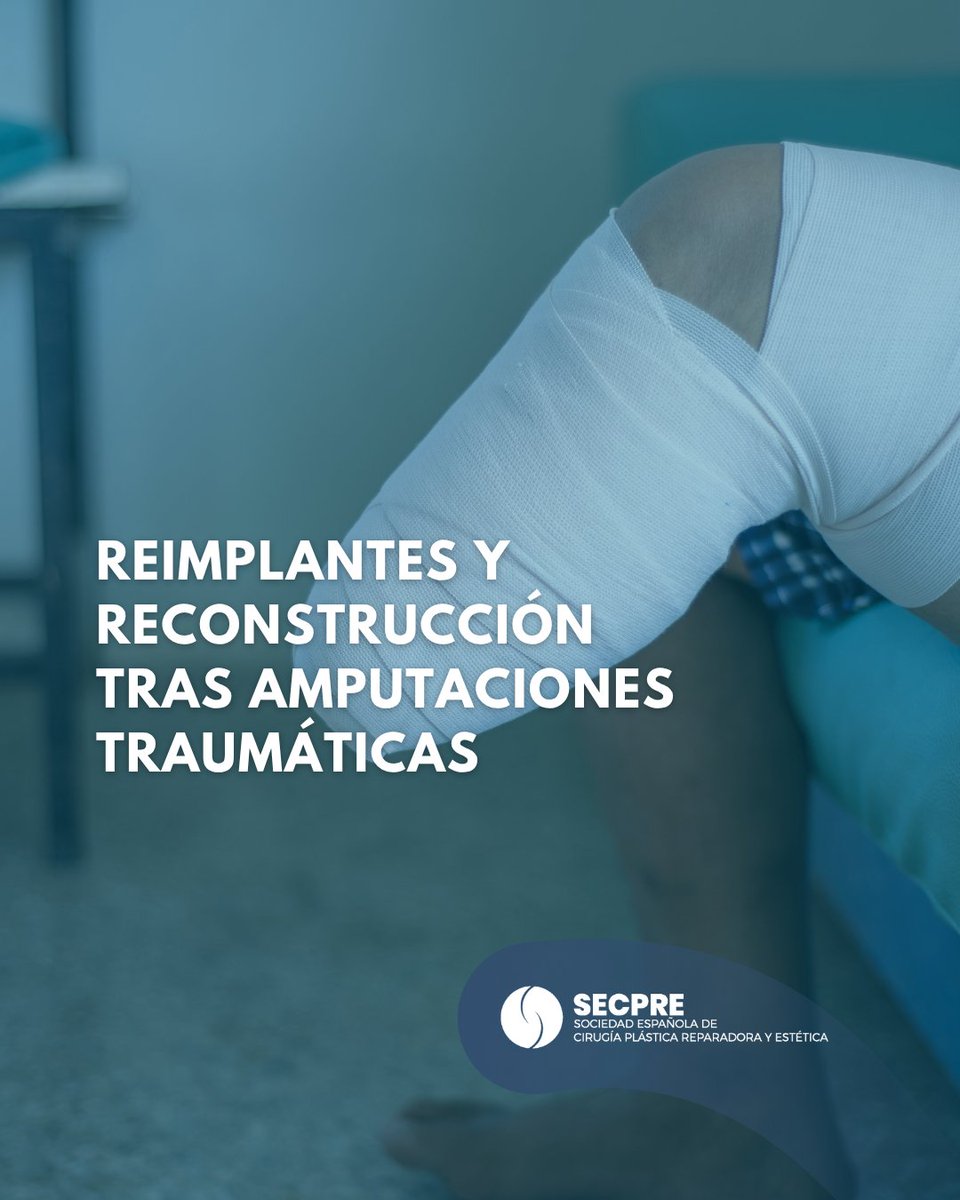 SECPREorg's tweet photo. Las amputaciones traumáticas requieren una actuación urgente y especializada.

🔹 La microcirugía puede permitir el reimplante y recuperar función
🔹 Si no es posible, la reconstrucción ofrece alternativas
🔹 Abordaje multidisciplinar y rehabilitación son clave https://t.co/1MqVGvYnXE
