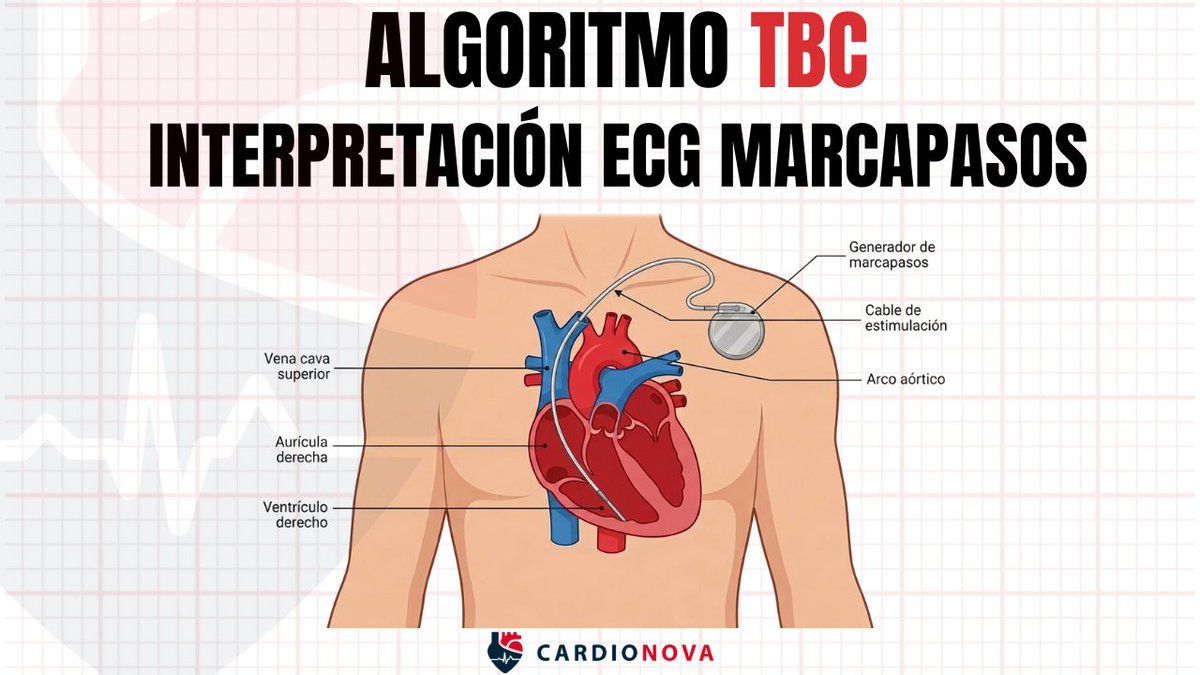 AppCardioNova's tweet photo. 🧵 ¿Te bloqueas al interpretar un ECG con marcapasos? 🫀

No eres el único.

Si no estás habituado, distinguir un funcionamiento normal de una disfunción puede ser complicado.

Hay una regla sencilla que puede ayudarte en segundos: el algoritmo TBC 👇 https://t.co/owddb7wBO5