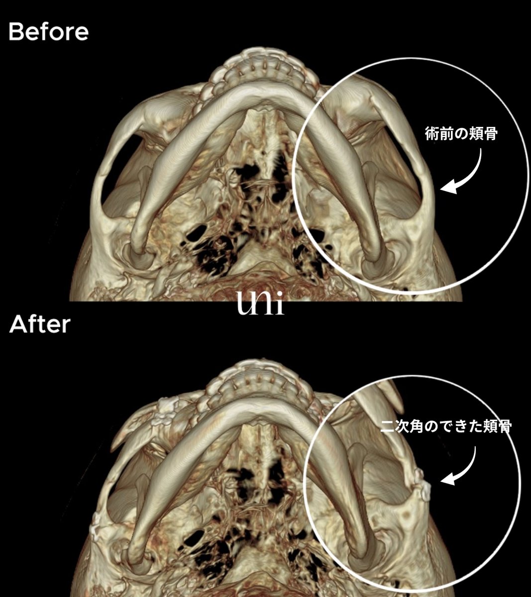 Uniprs_jp's tweet photo. ＜ #頬骨縮小 では縮小できない頬骨 ＞

CTで見えるこの部分(もみあげ)は、
ピン固定のために残さなければならない骨です。

そのため、
「縮小が足りなかった？」

と不安になる方もいらっしゃいますが
実際には頬骨が残っているのではなく、
骨を内側へ移動させることで出来てしまう"二次角"です。

特に皮膚の薄い方は、
凹凸として触れることがあるため
当院ではピン除去時に状態を確認し、
必要に応じてシェービングを行い滑らかに整えております。

#韓国整形 #輪郭手術 #ユニ美容外科 
📨公式LINE https://t.co/OtjT6H5NP8