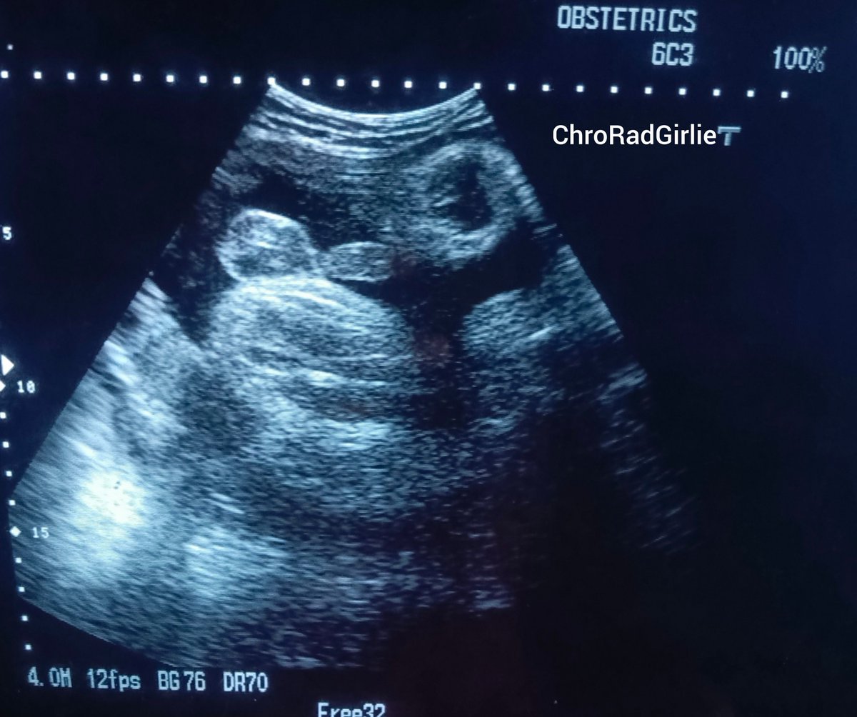 ChroRadGirlie's tweet photo. I told this lady that her baby was a baby boy.
The lady looked all surprised, then I asked what the problem was, she said; 'the last scan I did, I was told that my baby was a girl'

I smile, and assured her it was a boy instead. 

Dear Sonologist/Sonographers, there's absolutely nothing wrong in saying you didn't see the gender, when in doubt. 

Stop making people doubt the accuracy of Ultrasound in detecting/determining gender. 

@ChroRadGirlie