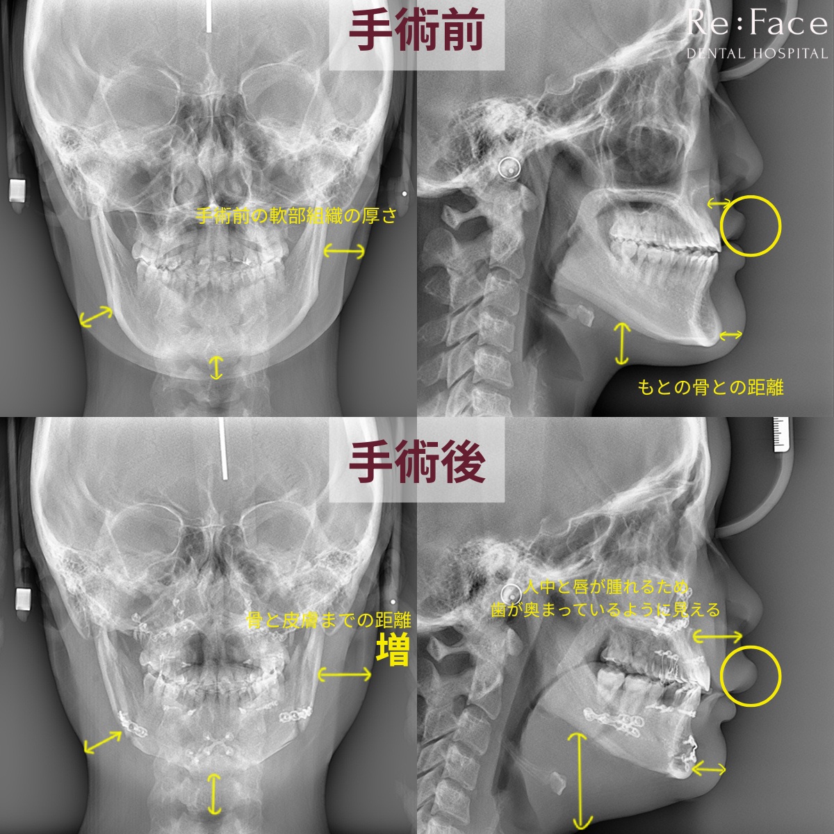Reface_hs's tweet photo. 「 X線で腫れを確認する方法 」

術後の腫れで不安になる方も多いと思いますが、
X線でも腫れの状態を確認することができます。

画像をご覧いただくと、
術前と術後では骨から皮膚までの厚みが大きく異なります。

これは腫れによる膨張であり
まだ完成形を判断するには早い状態です。

特に喉の部分や人中は腫れが強く出やすく

・人中が長く見える
・歯が奥まって見える
・笑った時に歯が見えにくい

といった両顎手術後ならではのお悩みが出やすい時期でもあります。

これらは術後3ヶ月頃までは【腫れの影響】によって起こり得る変化ですが
気になる症状やご不安な点がございましたら、
手術を受けられた病院へお問い合わせいただくことをおすすめいたします。

公式LINE : https://t.co/fSgXxpe05g
#輪郭3点 #両顎手術 #輪郭手術 #リフェイス口腔外科