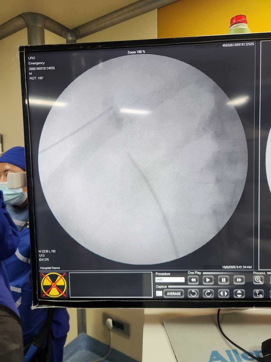 dr_khadgi's tweet photo. Supra 11 lateral puncture MPCNL to remove multiple stones from left upper pole. https://t.co/tmpsLwm3X9