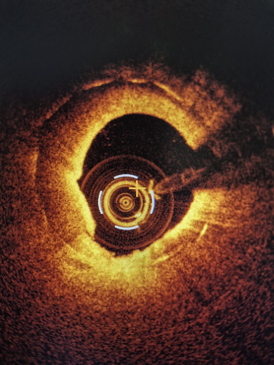 AsherElad's tweet photo. ISR in the LAD: when OCT tells the real story.
A patient presented with recurrent ISR in the LAD. OCT revealed clear features of in-stent neoatherosclerosis, with lipid-rich neointima and advanced neointimal transformation rather than simple neointimal hyperplasia.
This case highlights why angiography alone is often insufficient in ISR. Understanding the underlying mechanism is critical for selecting the optimal treatment strategy. Neoatherosclerosis is increasingly recognized as a major cause of late stent failure, recurrent ISR, and adverse clinical outcomes. 
(Images before and after stenting).

📖 Read our review on the mechanisms, imaging findings, and management of in-stent neoatherosclerosis: 
https://t.co/V5XIf0wSyp

#CardioTwitter #OCT #PCI #ISR #Neoatherosclerosis #InterventionalCardiology #LAD #CoronaryImaging #StentFailure #JUPITERStudyGroup 

@PCRonline @Sbrugaletta @Ortega_Paz @Anazmicalik @guilbom @hect2701 @NicolaRyanI1 @DrPascalMeier @W_jyg @ICigalini @Hragy @SABOURETCardio
@mmamas1973 @djc795 @GreggWStone @toreyj01 @EAPCIPresident @CMichaelGibson @SmithElliotjs @ArielRoguin @aayshacader @twj1974
#europcr @dangiloncardio @deharo_pierre
@DanieleGiacoppo @MilasinD18 @Taiebphil
@plateletdoc @realarainmd