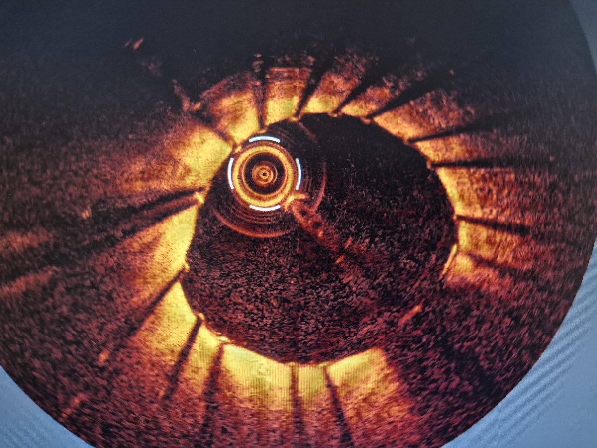 AsherElad's tweet photo. ISR in the LAD: when OCT tells the real story.
A patient presented with recurrent ISR in the LAD. OCT revealed clear features of in-stent neoatherosclerosis, with lipid-rich neointima and advanced neointimal transformation rather than simple neointimal hyperplasia.
This case highlights why angiography alone is often insufficient in ISR. Understanding the underlying mechanism is critical for selecting the optimal treatment strategy. Neoatherosclerosis is increasingly recognized as a major cause of late stent failure, recurrent ISR, and adverse clinical outcomes. 
(Images before and after stenting).

📖 Read our review on the mechanisms, imaging findings, and management of in-stent neoatherosclerosis: 
https://t.co/V5XIf0wSyp

#CardioTwitter #OCT #PCI #ISR #Neoatherosclerosis #InterventionalCardiology #LAD #CoronaryImaging #StentFailure #JUPITERStudyGroup 

@PCRonline @Sbrugaletta @Ortega_Paz @Anazmicalik @guilbom @hect2701 @NicolaRyanI1 @DrPascalMeier @W_jyg @ICigalini @Hragy @SABOURETCardio
@mmamas1973 @djc795 @GreggWStone @toreyj01 @EAPCIPresident @CMichaelGibson @SmithElliotjs @ArielRoguin @aayshacader @twj1974
#europcr @dangiloncardio @deharo_pierre
@DanieleGiacoppo @MilasinD18 @Taiebphil
@plateletdoc @realarainmd