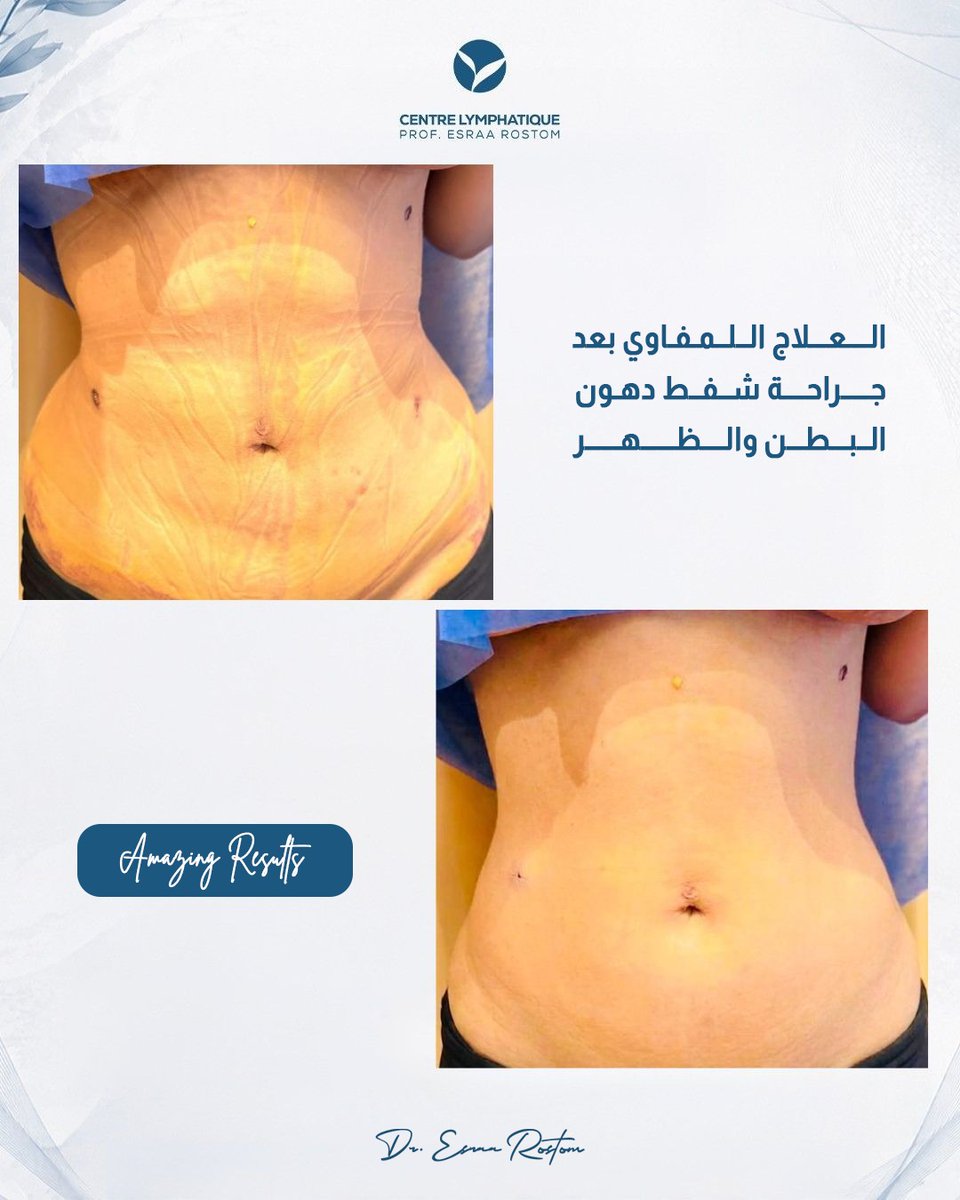 Esraarostom's tweet photo. نتيجة جلسات العلاج اللمفاوي بعد جراحة شفط دهون البطن والظهر . النتائج المميزة بعد عمليات شفط الدهون لا تعتمد على الجراحة فقط، بل على العناية الص��يحة بعد العملية أيضًا. ✨

جلسات العلاج اللمفاوي بعد شفط دهون البطن والظهر تساعد على تقليل التورم، تحسين تصريف السوائل المحتبسة، https://t.co/zmoqZxphhp