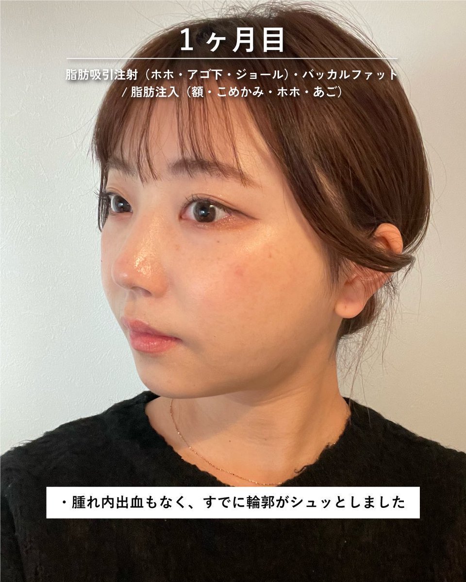 sbc_ushirozako's tweet photo. 【脂肪吸引注射で可愛く、垢抜けよう👱‍♀️】

脂肪吸引注射の特徴を挙げます👇
✅ダウンタイムが少ない
✅フェイスバンドが不要
✅傷口が最小限
✅脂肪吸引と同等の効果を期待できる

脂肪吸引注射後に、フェイスラインやアゴ下が明らかに変化しているのでおすすめです🙆‍♂️ダウンタイムも最小で周りからバレづらいため、翌日から仕事に行けます✨

ご予約はこちら👇
https://t.co/P0xKQCcUof