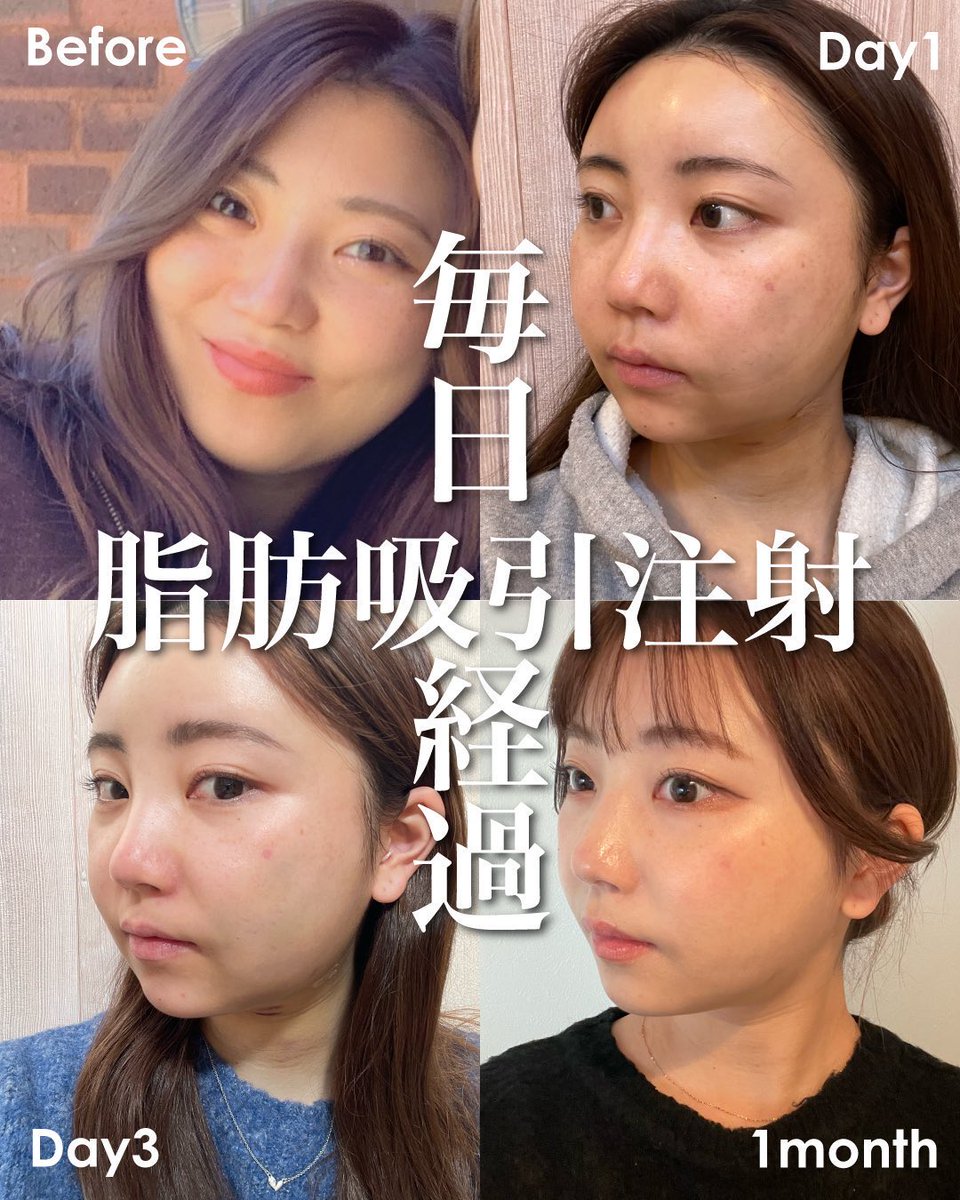sbc_ushirozako's tweet photo. 【脂肪吸引注射で可愛く、垢抜けよう👱‍♀️】

脂肪吸引注射の特徴を挙げます👇
✅ダウンタイムが少ない
✅フェイスバンドが不要
✅傷口が最小限
✅脂肪吸引と同等の効果を期待できる

脂肪吸引注射後に、フェイスラインやアゴ下が明らかに変化しているのでおすすめです🙆‍♂️ダウンタイムも最小で周りからバレづらいため、翌日から仕事に行けます✨

ご予約はこちら👇
https://t.co/P0xKQCcUof