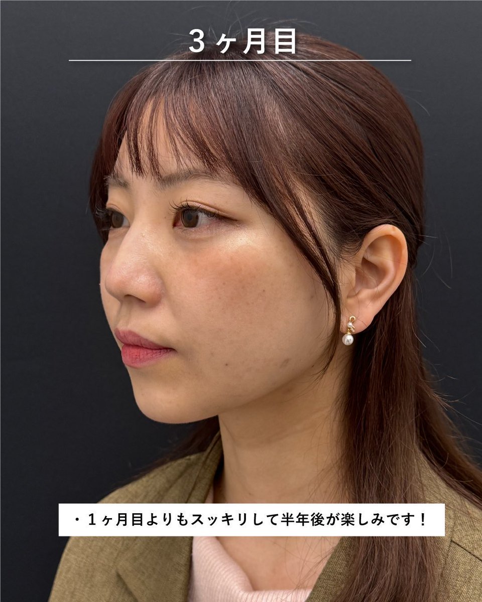 sbc_ushirozako's tweet photo. 【脂肪吸引注射で可愛く、垢抜けよう👱‍♀️】

脂肪吸引注射の特徴を挙げます👇
✅ダウンタイムが少ない
✅フェイスバンドが不要
✅傷口が最小限
✅脂肪吸引と同等の効果を期待できる

脂肪吸引注射後に、フェイスラインやアゴ下が明らかに変化しているのでおすすめです🙆‍♂️ダウンタイムも最小で周りからバレづらいため、翌日から仕事に行けます✨

ご予約はこちら👇
https://t.co/P0xKQCcUof