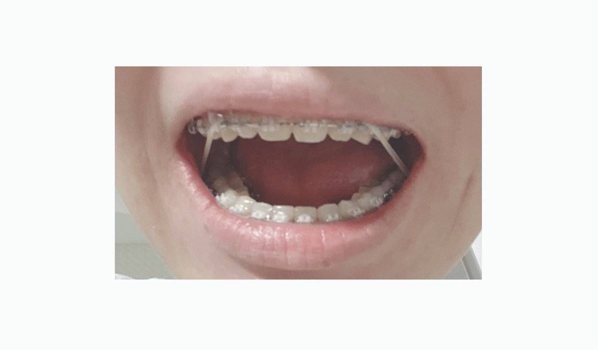 piyo_7e's tweet photo. 矯正日記🦷(26年6月10日)

ついに最終段階のゴムかけ生活始まりました🌟毎日つけるの大変そうやけど頑張る🥺

#ガミースマイル　#アンカースクリュー
#歯列矯正　#ワイヤー矯正　#矯正日記
#口ゴボ https://t.co/T5Ms7M1cqy