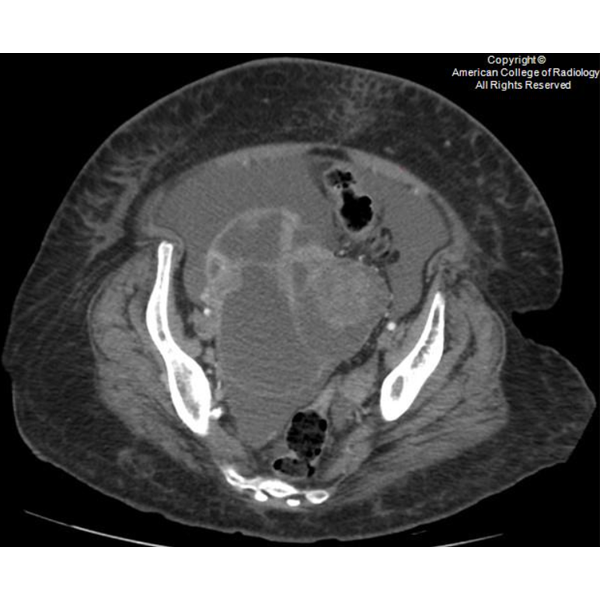 RadiologyACR's tweet photo. A 63-year-old female presents to the ED with progressively worsening abdominal pain, abdominal distension, and difficulty with bowel movements. #ACRCaseinPoint https://t.co/HNZO1ZVVRU https://t.co/Qz7p9SceKv